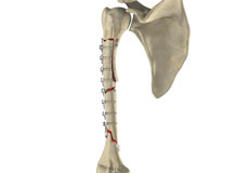 Complex Fracture Repair of the Shoulder