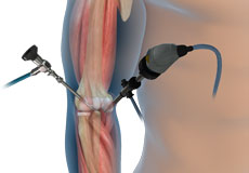 Elbow Arthroscopy