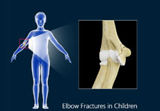 Elbow Fracture