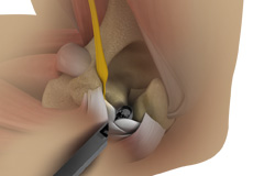 Endoscopic Cubital Tunnel Release