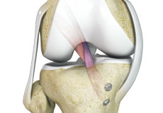 Knee Ligament Reconstruction