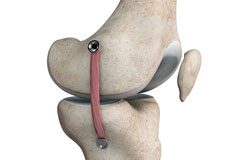 MCL Reconstruction