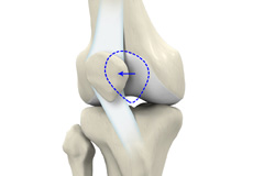 Patellar Instability