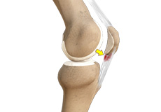 Patellar Tendinitis