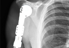 Proximal Humerus Resection and Reconstruction