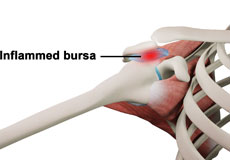 Rotator Cuff Bursitis