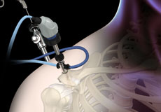 Arthroscopic Surgery