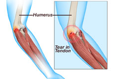 Tennis Elbow